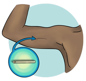 Contraceptive implant