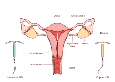 uterus and IUDs